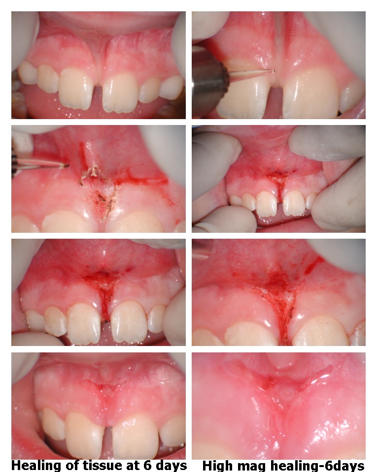 Frenectomy collage.jpg